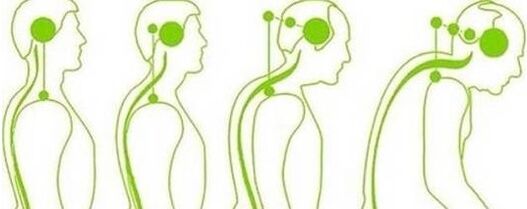 Cervical spinal loses mobility