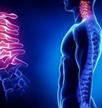 Neck injuries can be the cause of cervical osteochondrosis