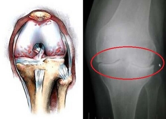 osteoarthritis of the knee joint